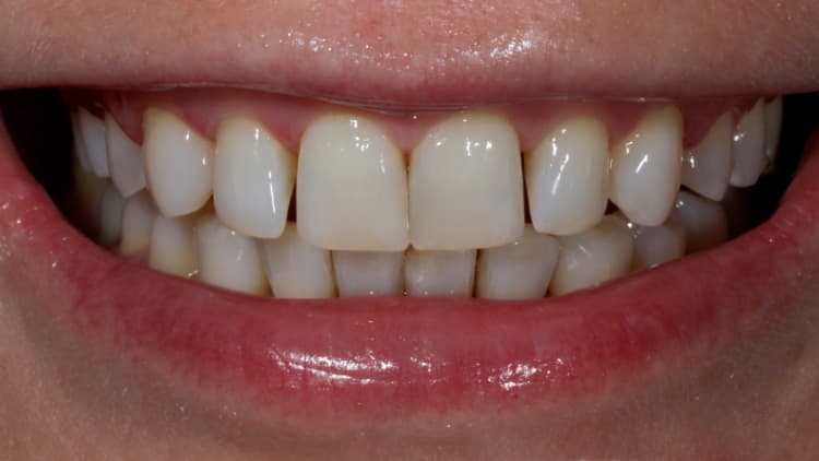 Отбеливание зубов