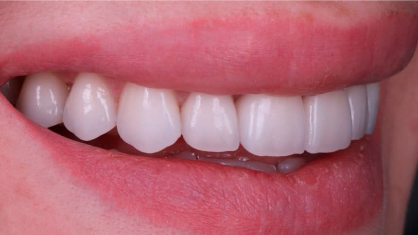 Установка виниров