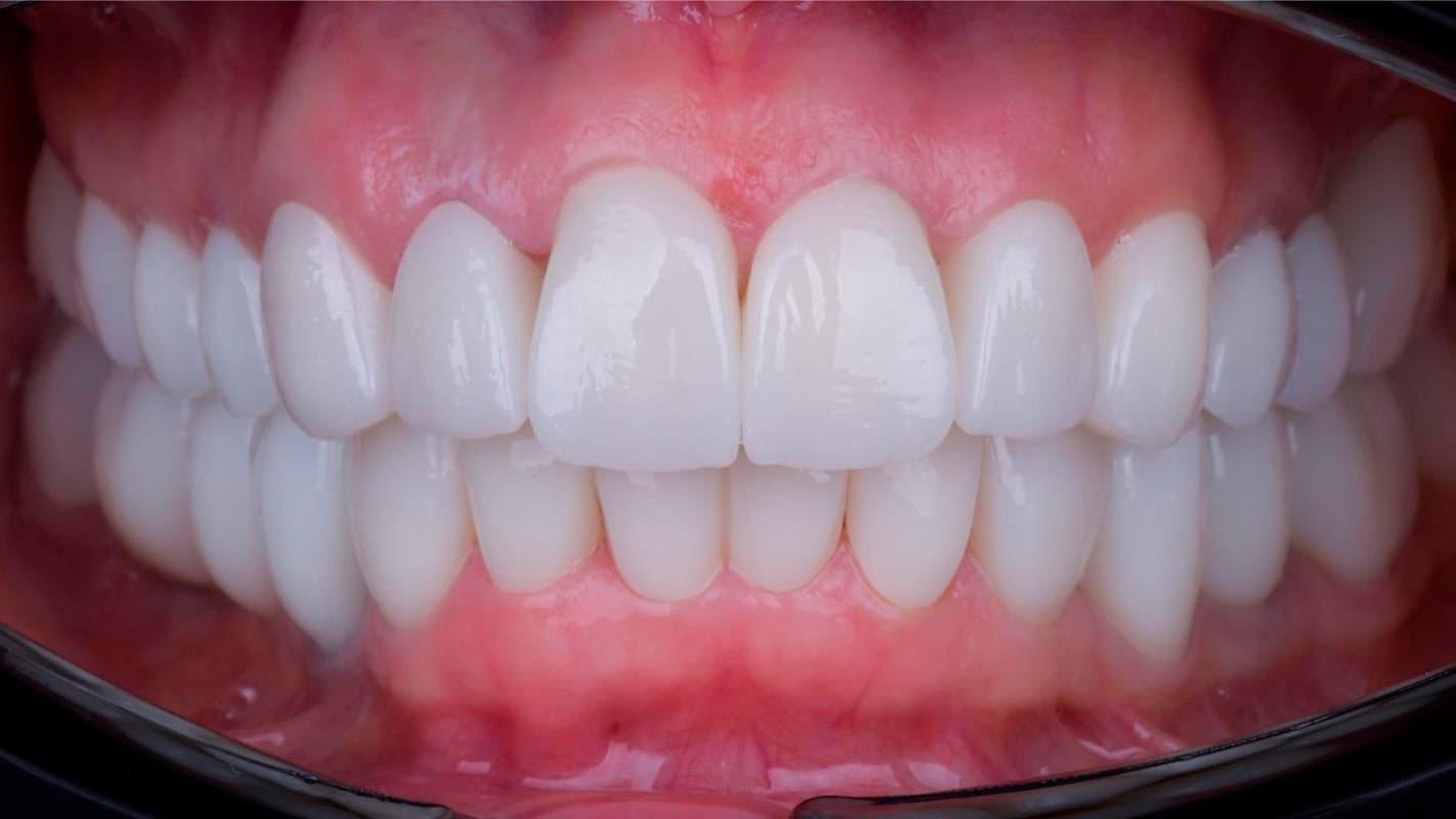 Имплантация All-on-4 — после