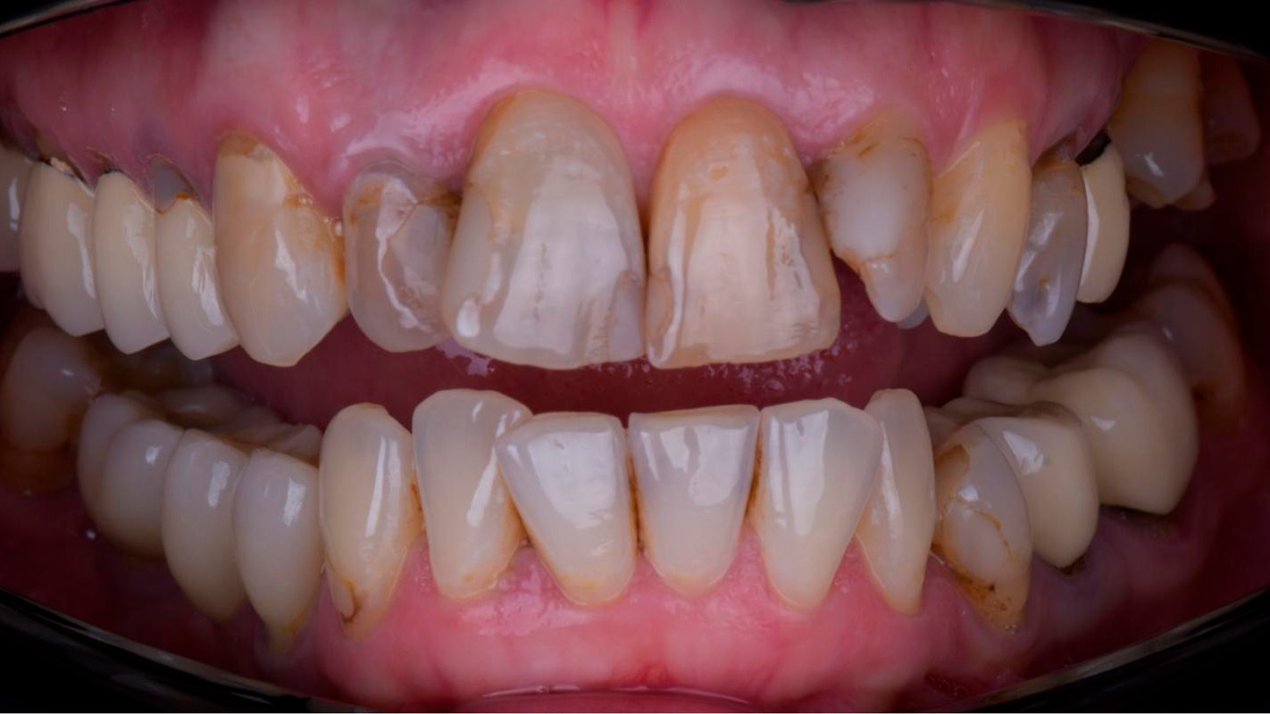 Имплантация All-on-4 — до